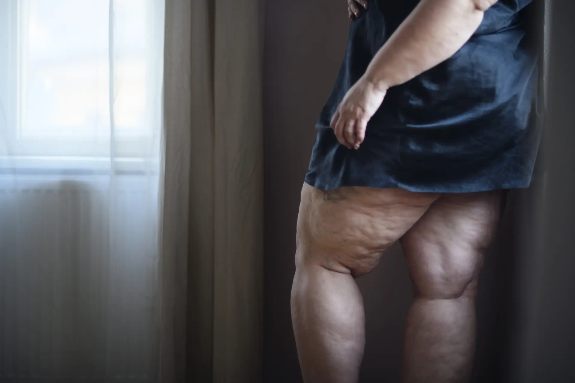 Person standing indoors near a window, showing enlarged legs with visible fat distribution associated with Lipedema Physiotherapy focus.