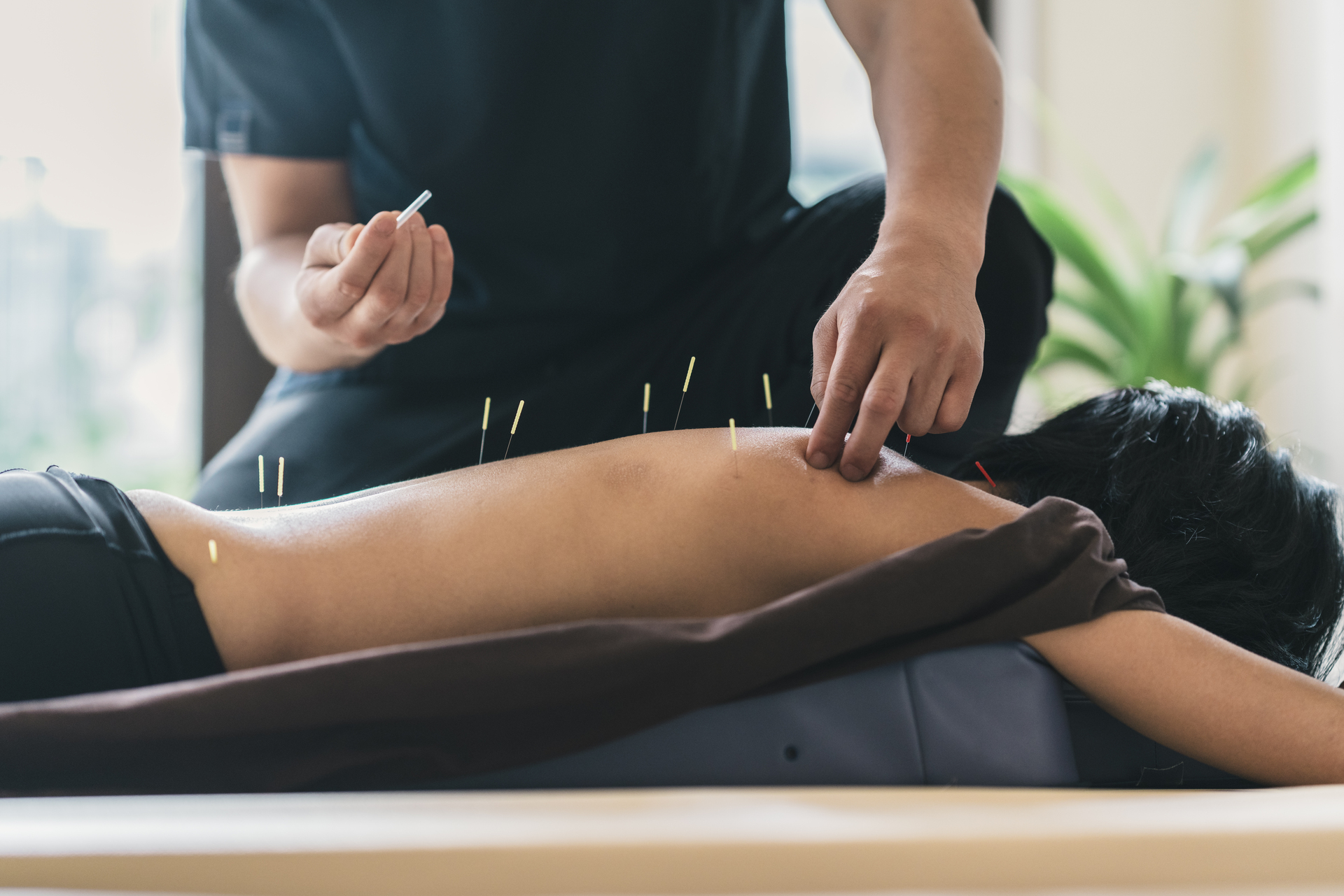 Therapist performing acupuncture on a woman’s back with multiple needles, illustrating Acupressure vs Acupuncture techniques in a wellness setting.