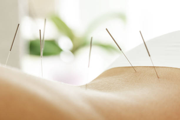 Traditional Chinese Acupuncture In Edmonton Treatment Session Focusing On Pain Relief And Holistic Healing Traditional Chinese Acupuncture In Edmonton Treatment Session Focusing On Pain Relief And Holistic Healing
