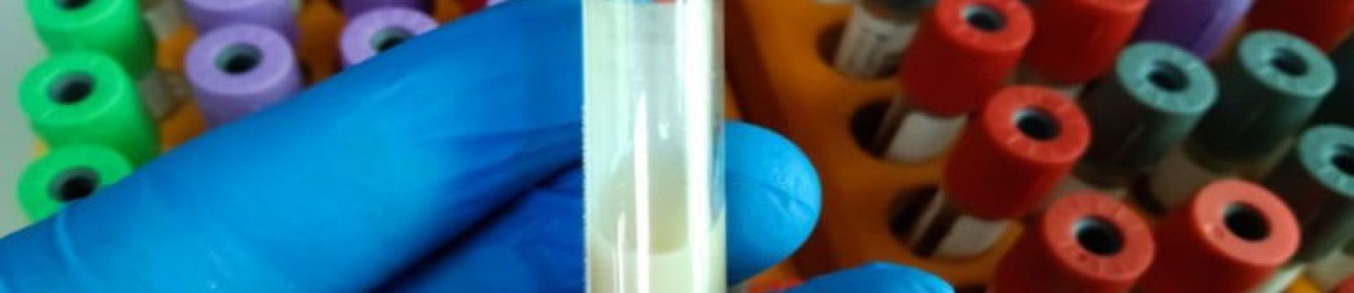 Gloved hand holding a blood sample test tube in a laboratory, Lipoedema Treatment Edmonton